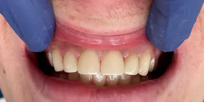 Discoloured front teeth — after treatment