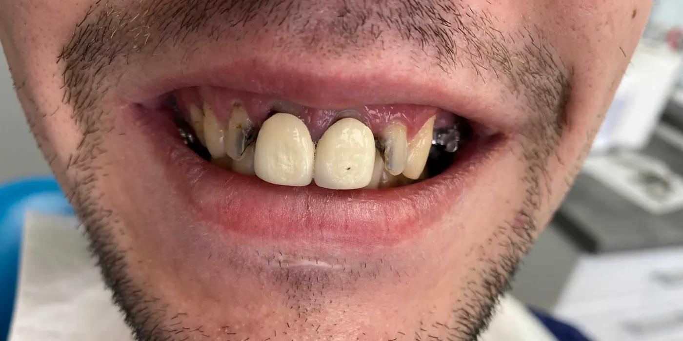 Kazy a chýbajúci zub — pred ošetrením