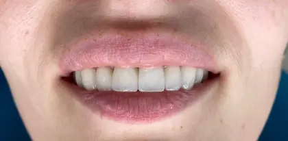 Worn front teeth — after treatment