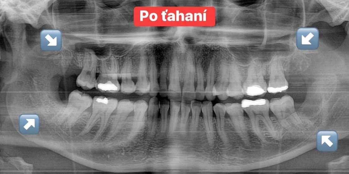 Zuby múdrosti — röntgen pred a po — po ošetrení