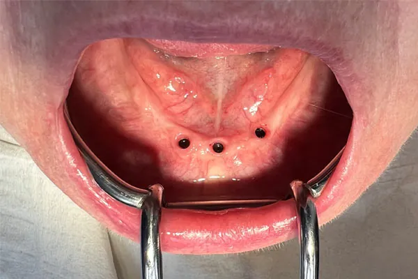 Tri zavedené implantáty v dolnej čeľusti